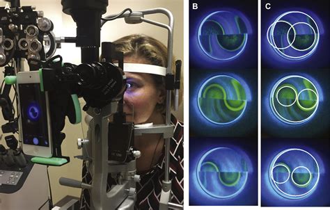 tonometry probe procedure